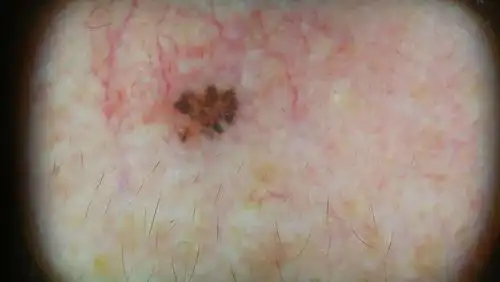 bcc的皮肤镜表现