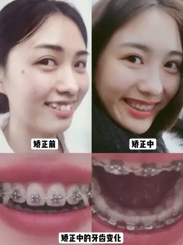 虎牙破坏气质?小姐姐矫正变身成熟女神!