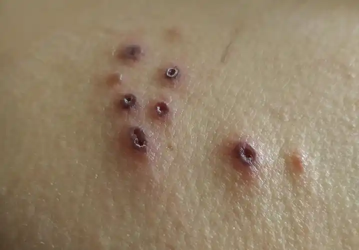 图片上是哪种皮肤病?