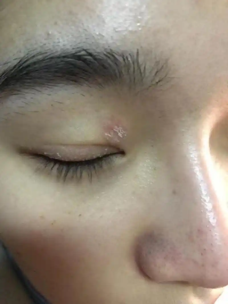 眼皮是人体皮肤最薄的部位之一.