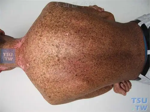 着色性干皮病(xeroderma pigmentosa)症状表现 - 皮肤病学 - 天山医学