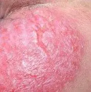 查看详细>>  肛周湿疹是一种很尴尬的疾病,患者瘙痒难忍,可发于任何