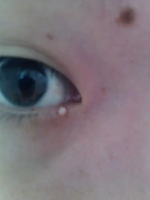 眼睑靠近眼角的地方长了一个米粒大小的包