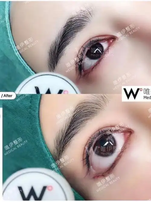 外眼角无痕下至术后效果对比