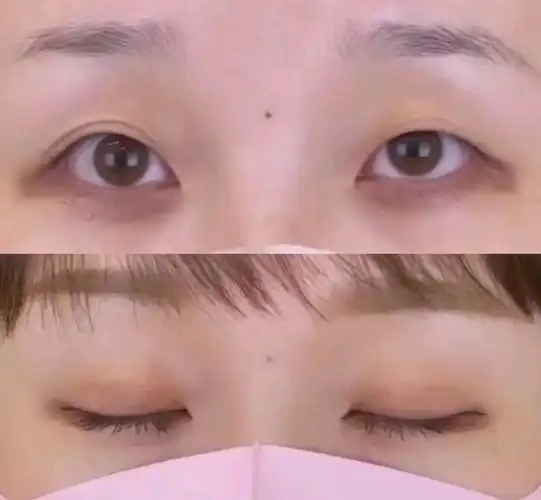 全切双眼皮 提肌无力一个月反馈