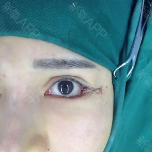 【外眼角下至术后第一天】#下眼睑下至#外眼角