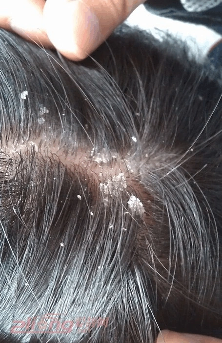 头皮银屑病症状和图片及护理方法