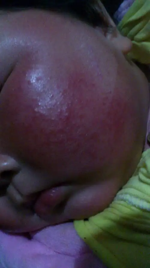 五个月宝宝脸上是什么?