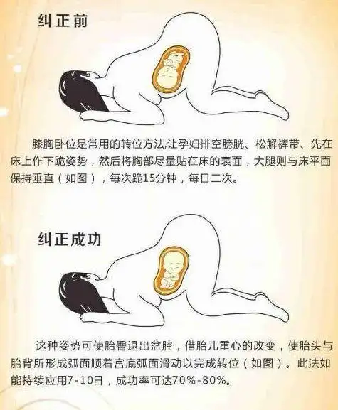 当b超单显示臀位,就一定要剖腹产吗?6周内调成头位,还可顺产_胎儿