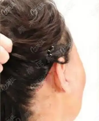 北京柳民熙医生做的小切口拉皮手术实拍案例图片十年后没有老很多