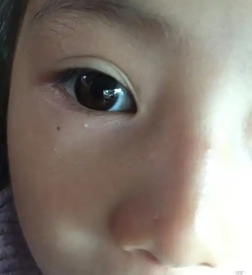 我晕,我女儿眼睛下面生脂肪粒了,难道也去挑掉?