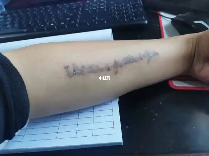 12cm纹身切除12cm疤痕影响考公吗