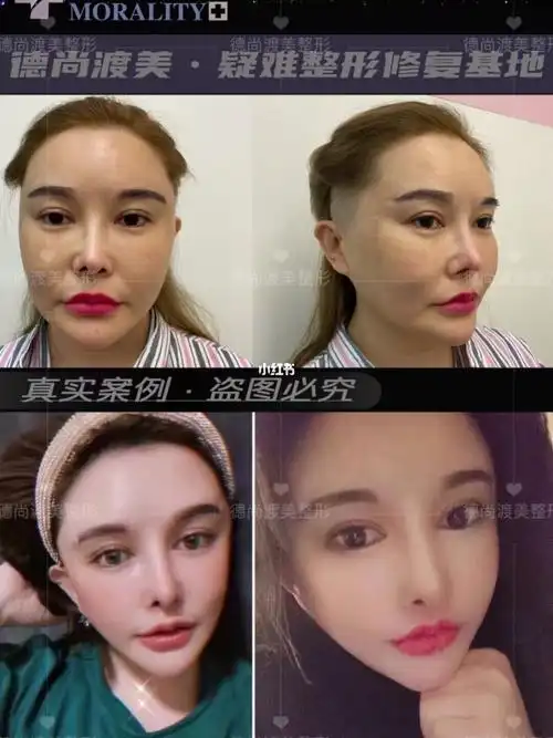 面部拉皮术后七个月