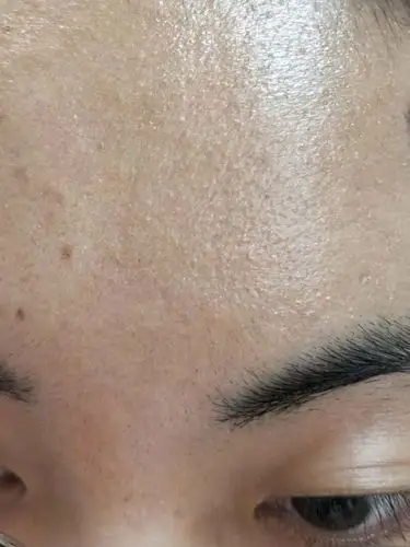 皮肤敏感痒治疗后恢复了正常皮肤情况