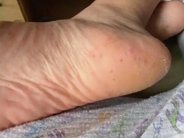 脚底起红点很痒很疼怎么办