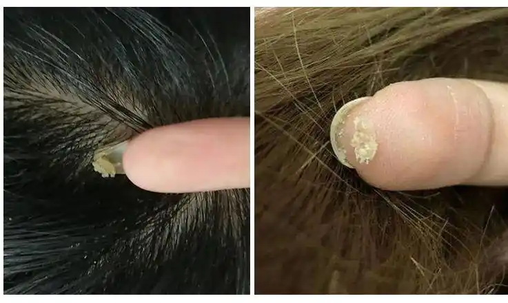 还会引发毛囊炎,头皮发红,长痘痘的现象,引起头皮屑的爆发.