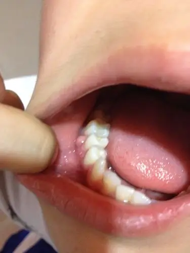 牙龈上长一肉包,不痛不痒.