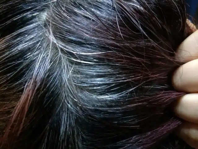 很多年轻人有白头发,一部分是遗传了父母,也就是我们俗称的"少白发"