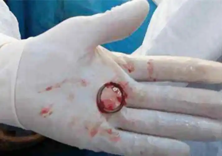 几乎和自己的儿子同龄,现在已经深深地现在她的血肉中,要想取出来