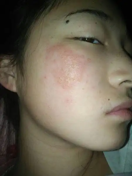 抹护肤品脸过敏了怎么办(脸涂护肤品过敏了怎么办)-大恒化妆网