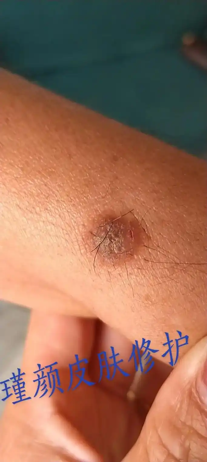 增生瘊子尽早祛除瑾颜皮肤修护中心博华小区齐兵超市对过电话