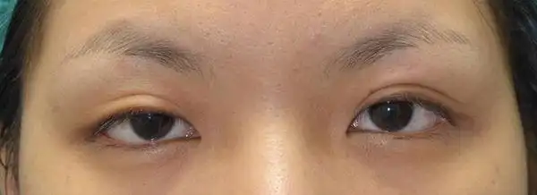 【案例照片】苏毓彬医师│双眼皮手术-提眼脸肌无力术前术后1个月