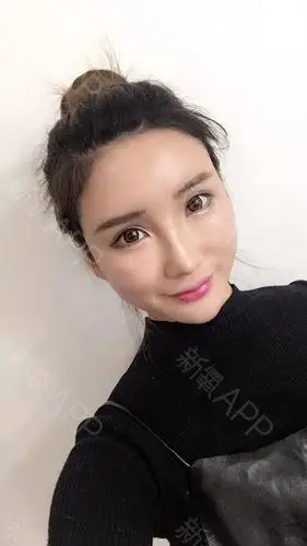 自体脂肪填充全脸