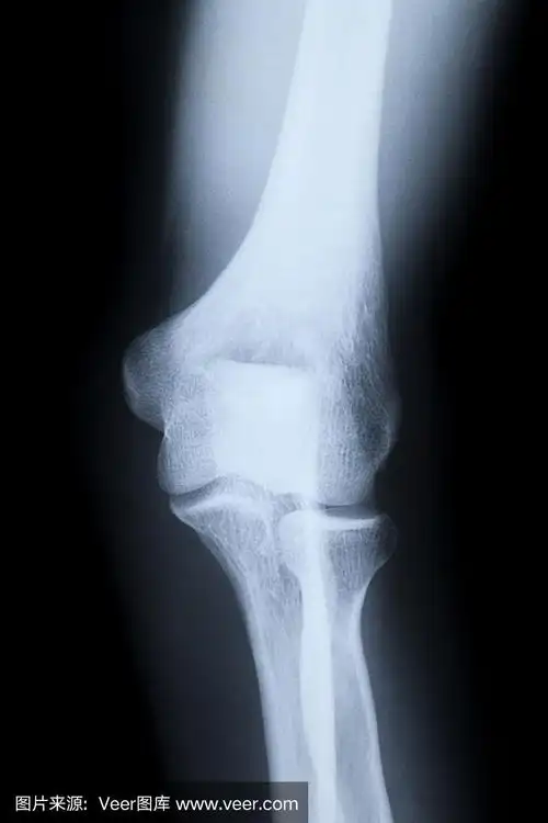 肘部x射线