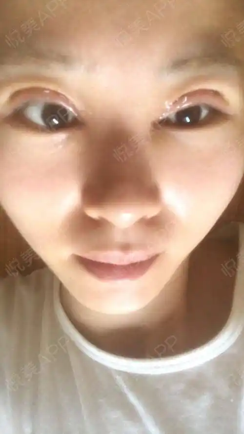埋线双眼皮术后2天_眼综合术后2天_双眼皮术后2天_眼部整形术后2天