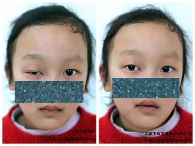 是什么引起了上眼睑下垂?