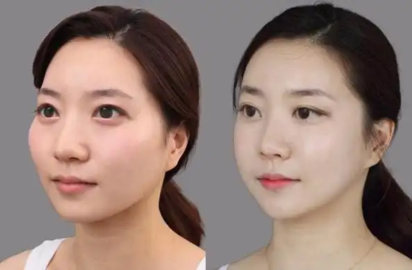 打美白针需要注意什么吗?