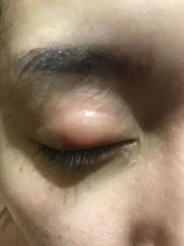 眼睛上长了个包,有点痒