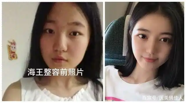 项思醒毕业旧照曝光,丑小鸭变身"女海王"做了哪些整形项目?