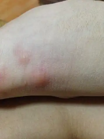 被虫子咬了起了两个硬硬的包有点痒,谁知道是什么虫子咬的?