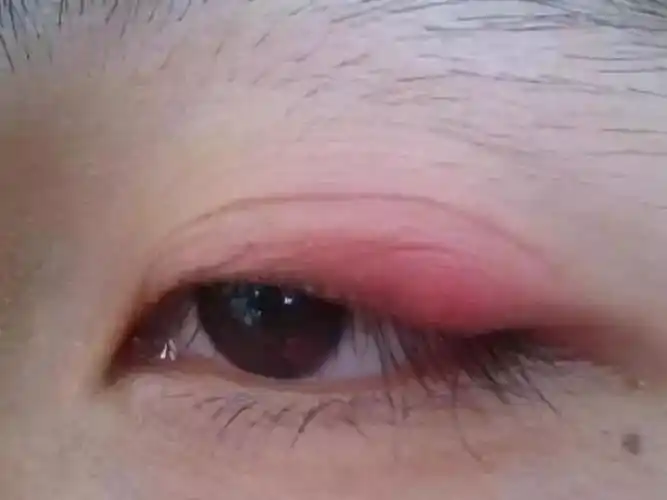 当心眼睛出现红血丝可能不是休息不好而是疾病在作怪