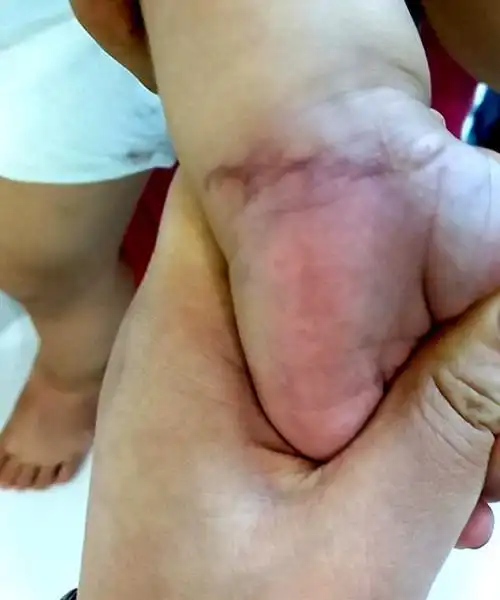 术后一个月,宝宝的手恢复良好