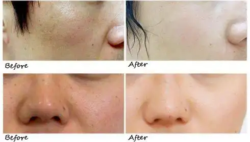 美白针前后对比