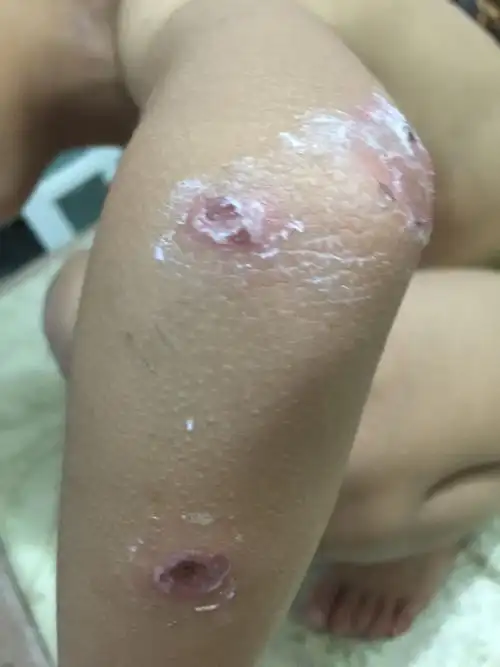 儿童全身从头到脚出现皮肤溃烂怎么办?