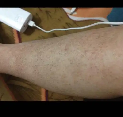 小腿皮肤还出现色素沉着,毛孔粗大,偶尔部分地区出现毛囊炎