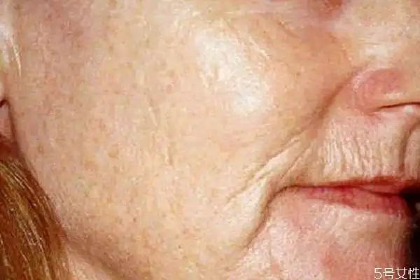 运动减肥皮肤会松弛吗 瘦下来后如何收紧皮肤