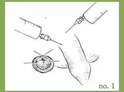 以上就是云南协和医院“ 韩式无痕包皮美容术”治疗包皮