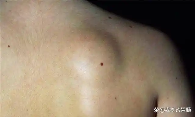 其实肉瘤与癌症一样都是恶性肿瘤,它与癌不同的是两者组织起源不同.