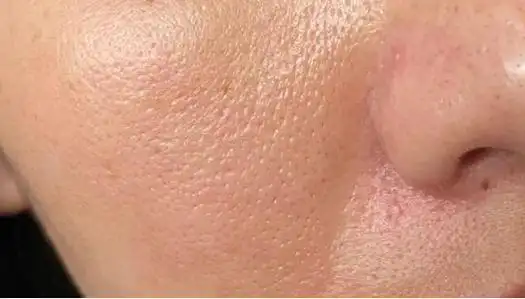 毛孔粗大怎么办?教你轻松缩小毛孔