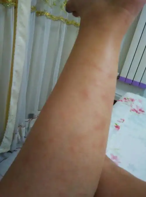 小腿肚上长了这些东西,有人知道是什么原因吗,有图片