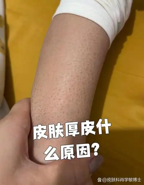 皮肤厚皮最常见的原因有两个:一是长期摩擦刺激,二是皮肤角化症