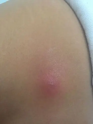 后背腰部右侧长了一个浓疥子 已经三四天了 现在越