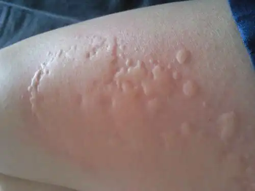 平白无故的大腿出现了红疙瘩是毒素吗