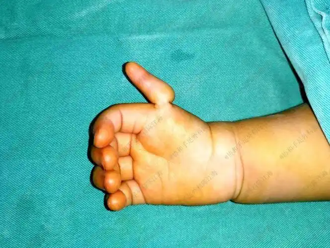 这个宝宝的大拇指是怎么回事产检能检查出来吗