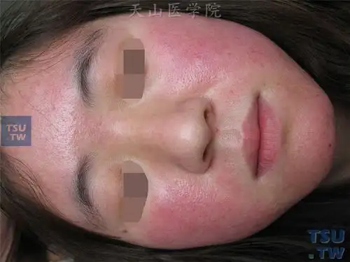 【图】化妆品皮炎(cosmetic dermatitis)的症状表现 - 皮肤病诊断图谱