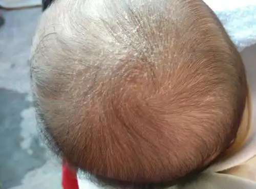 2016-01-13 17:58    浏览  33333  推荐回答 你好,考虑头皮糠疹